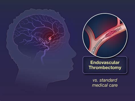 Endovascular thrombectomy after large